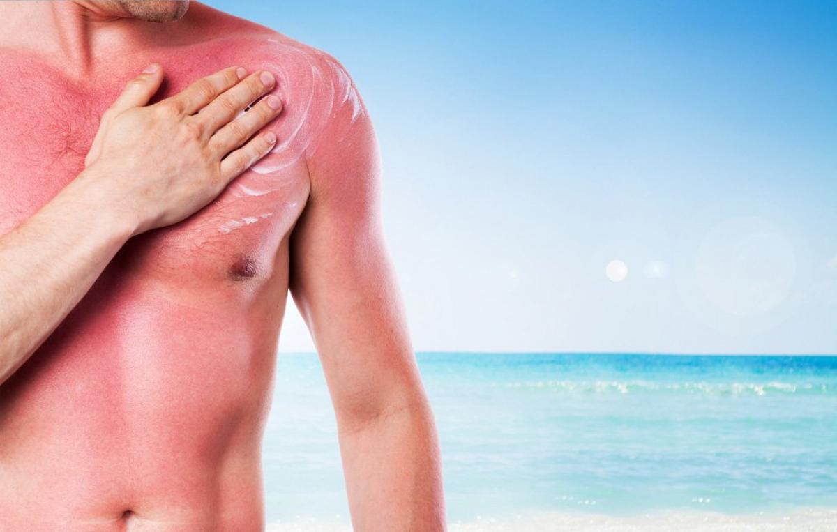 How to soothe a sunburn